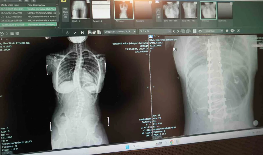 Omurgasında 45 derece eğrilik bulunan skolyoz hastası 15 yaşındaki Elsa